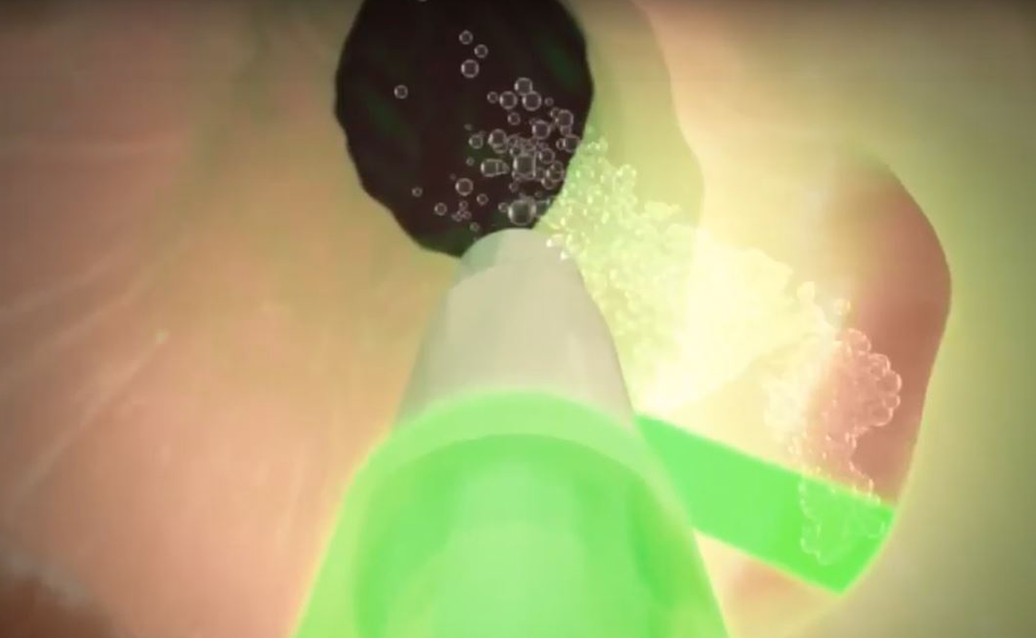 Photoselective Vaporisation of the Prostate (PVP) therapy illustration.