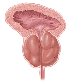Enlarged prostate illustration.