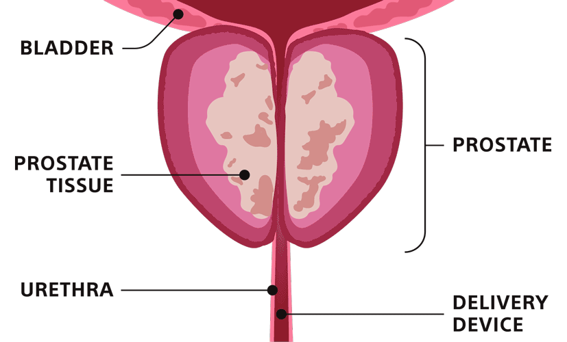 BPH Vapor Therapy With Rezūm Steam Treatment for BPH